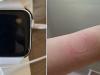 Apple Watch SE suferă de supraîncălzire, conform unor utilizatori din Coreea de Sud; Caţiva au avut urme roșii pe piele