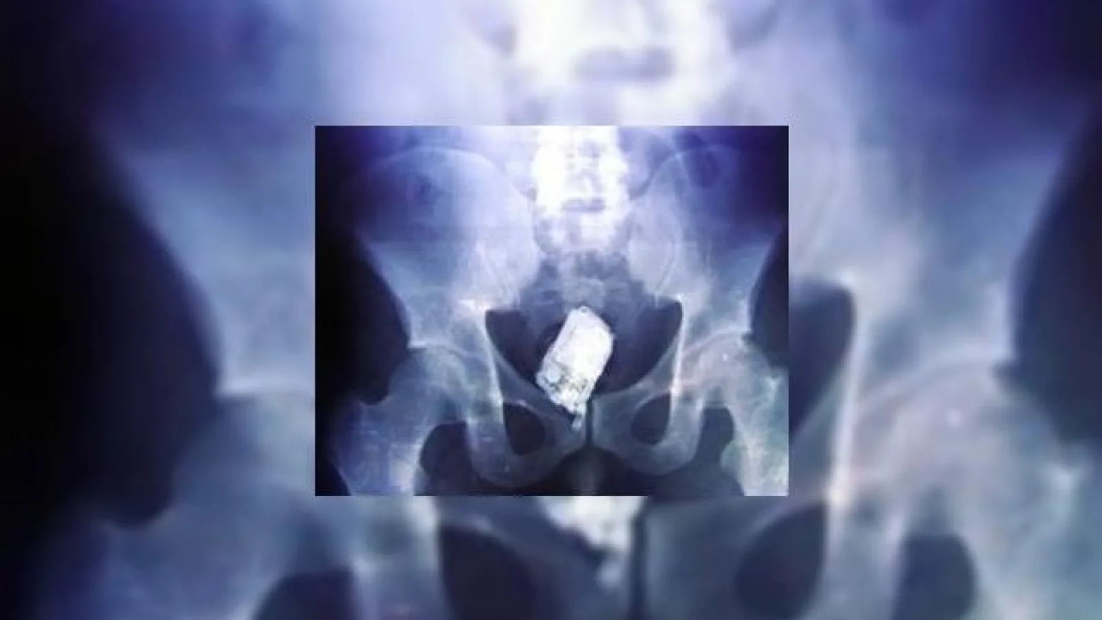 Telefoanele "dosite" se vad la radiografie