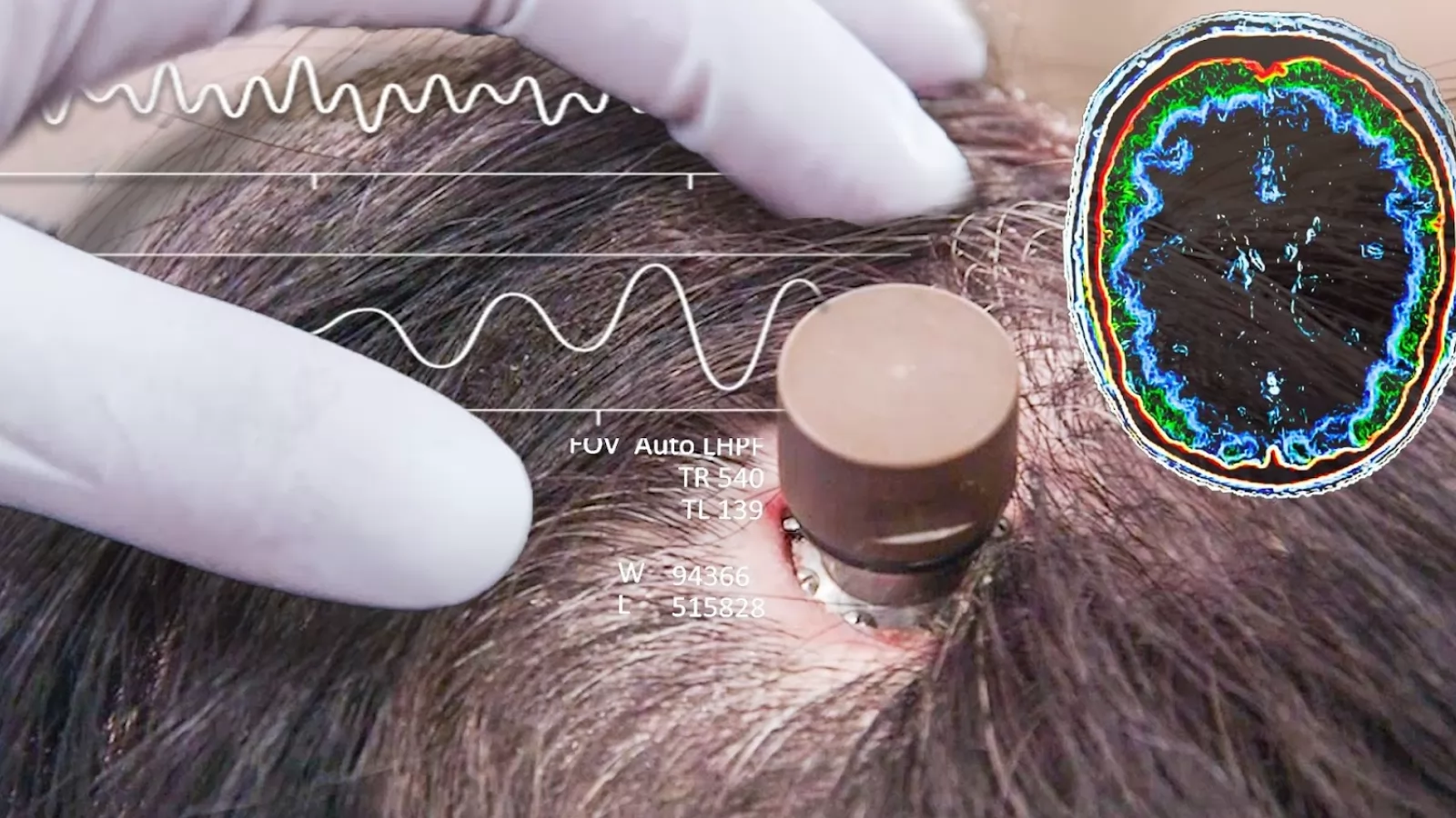 Elon Musk începe testele pe oameni cu Neuralink în 2023: cipuri instalate în creiere umane