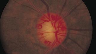 Google foloseşte AI-ul pentru a prezice bolile de inimă prin scanarea oculară
