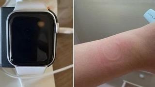 Apple Watch SE suferă de supraîncălzire, conform unor utilizatori din Coreea de Sud; Caţiva au avut urme roșii pe piele