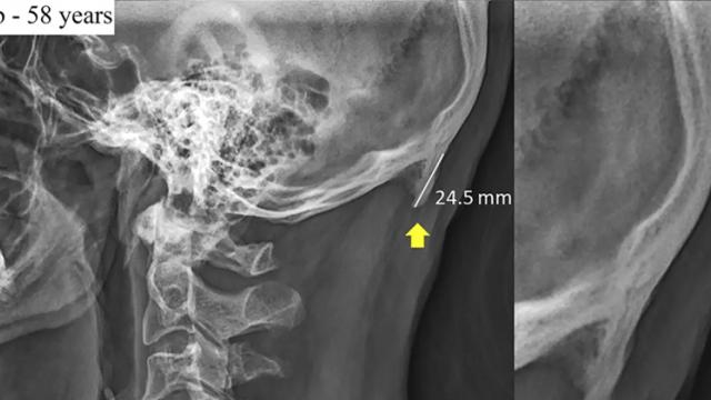 <b>Utilizarea excesivă de smartphone face să îţi crească... coarne!? Iată rezultatul unui studiu asupra craniilor tinerilor</b>OK, am strâmbat din nas când am auzit de acest studiu. Dar când Fortune.com, NBC sau Washington Post scriu despre asta, e treabă serioasă. Cercetători de la Universitatea Sunshine Coast din Queensland